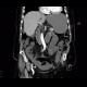 Ileus, bowel ischemia: CT - Computed tomography